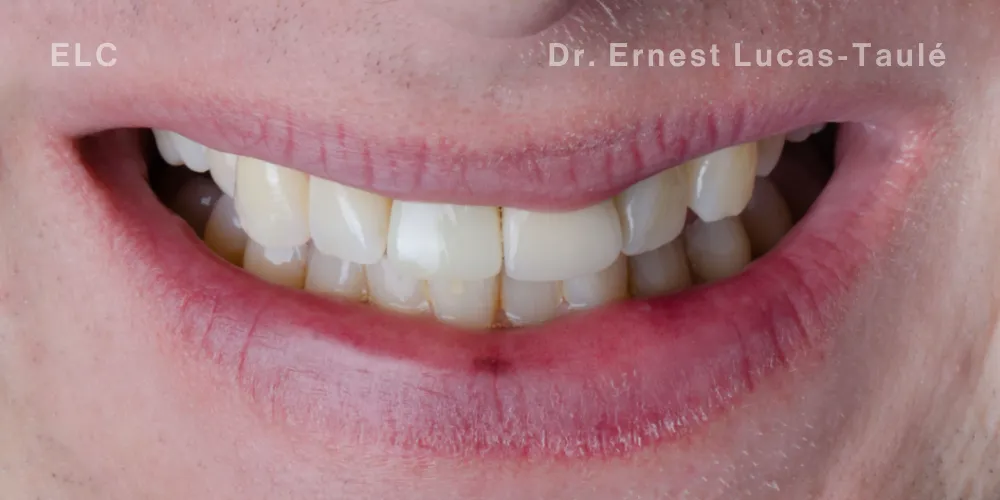 Close-up clinical view of the patient’s mouth with missing tooth replaced by an implant