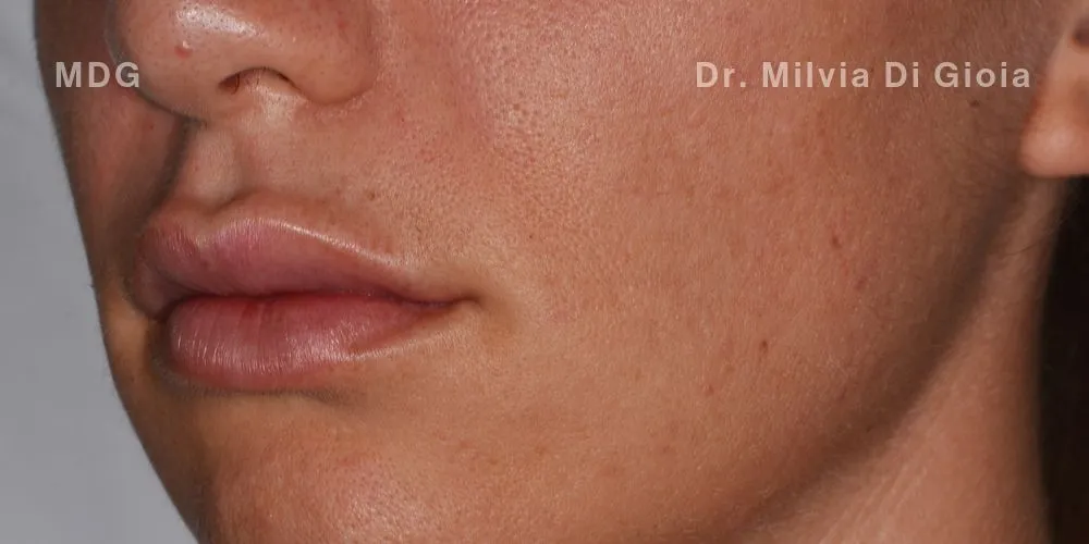 Close-up clinical view of the patient’s teeth following teeth whitening treatment. The teeth show a bright white hue (B1 shade), captured as an 'after' shot for dental whitening treatment.