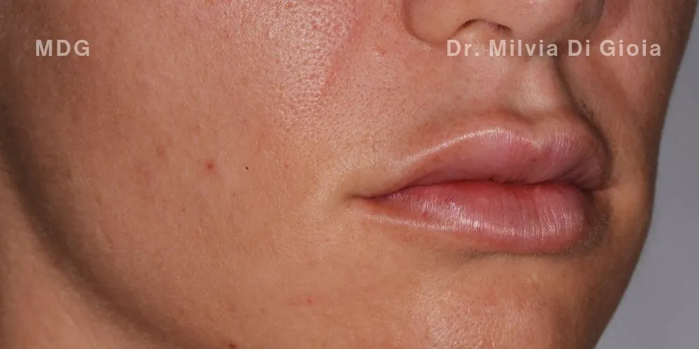 Close-up clinical view of the patient’s upper front teeth following edge bonding treatment. The biting edges are now perfectly straight, symmetrical, and smooth, complementing the previously corrected gum line and orthodontic alignment.