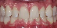 Close-up clinical view of the patient’s upper front teeth following edge bonding treatment. The biting edges are now perfectly straight, symmetrical, and smooth, complementing the previously corrected gum line and orthodontic alignment.