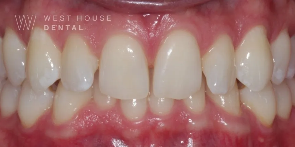 Close-up clinical view of the patient’s upper front teeth following edge bonding treatment. The biting edges are now perfectly straight, symmetrical, and smooth, complementing the previously corrected gum line and orthodontic alignment.