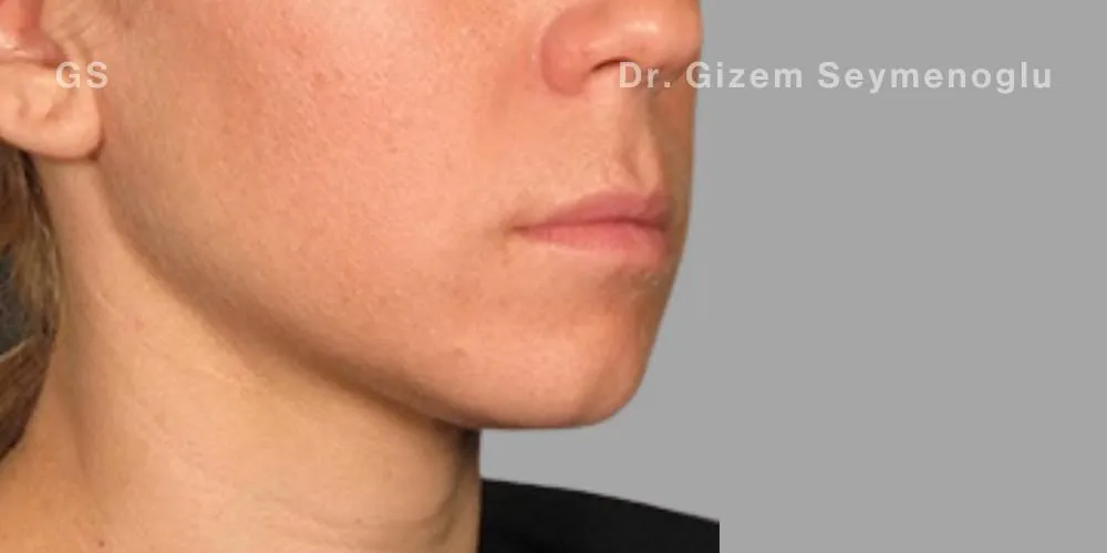 Close-up clinical view of patient after Aqualyx treatment showing a significant reduction in submental fat and a more contoured chin profile, captured as an 'after' shot for fat-dissolving injection treatment.