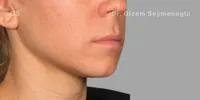Close-up clinical view of patient after Aqualyx treatment showing a significant reduction in submental fat and a more contoured chin profile, captured as an 'after' shot for fat-dissolving injection treatment.