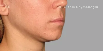 Close-up clinical view of patient before Aqualyx treatment showing a double chin and excess submental fat, captured as a 'before' shot for fat-dissolving injection treatment.