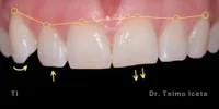 Close-up clinical view of a patient’s upper front teeth following orthodontic straightening and gum line correction. The teeth show minor unevenness and small chips at the biting edges, captured as a 'before' shot for dental edge bonding treatment.