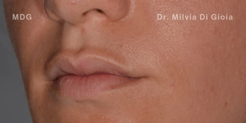 Close-up clinical view of a patient’s teeth prior to teeth whitening treatment. The teeth show a yellowish hue (B3 shade), captured as a 'before' shot for dental whitening treatment.