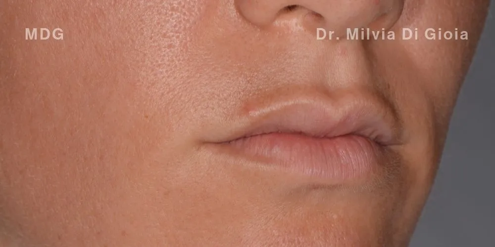 Close-up clinical view of a patient’s upper front teeth following orthodontic straightening and gum line correction. The teeth show minor unevenness and small chips at the biting edges, captured as a 'before' shot for dental edge bonding treatment.