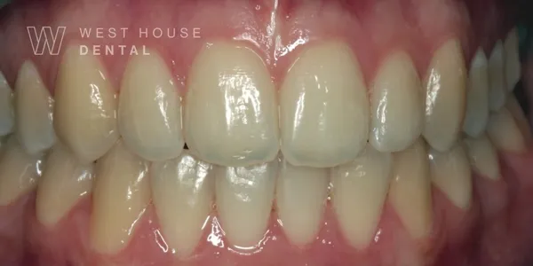 Close-up clinical view of a patient’s upper front teeth before whitening and straightening.