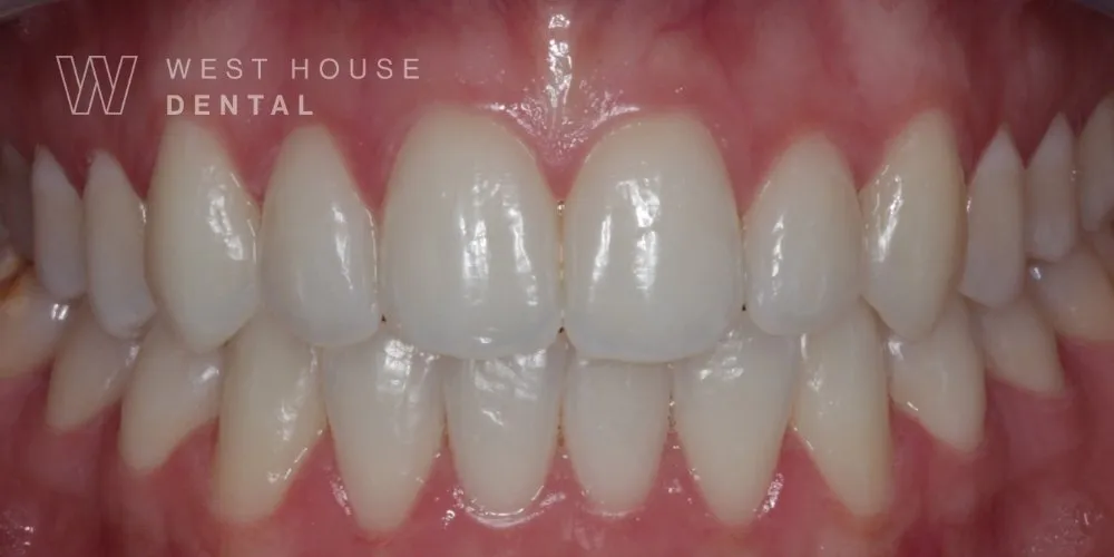 Close-up clinical view of the patient’s upper front teeth after whitening and straightening.