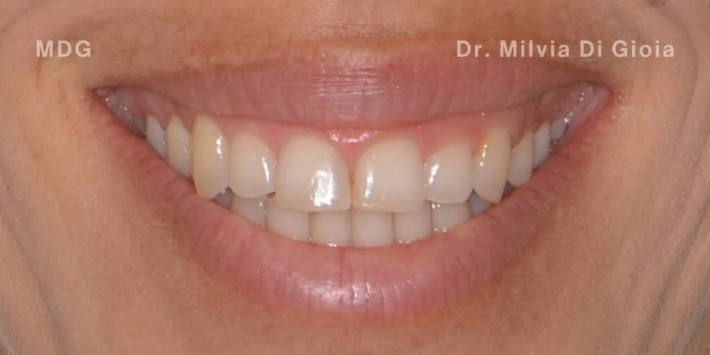 Close-up clinical view of the patient’s teeth following teeth whitening treatment. The teeth show a bright white hue (B1 shade), captured as an 'after' shot for dental whitening treatment.