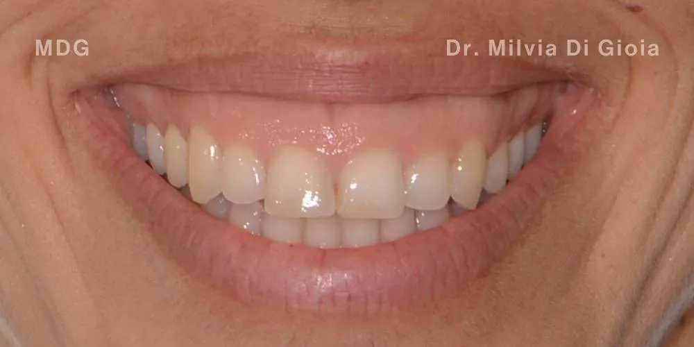 Close-up clinical view of a patient’s teeth prior to teeth whitening treatment. The teeth show a yellowish hue (B3 shade), captured as a 'before' shot for dental whitening treatment.