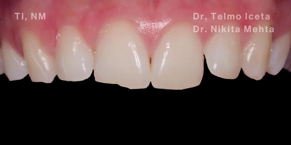 Close-up cinical view of a patient's upper front teeth showing fractures and jagged edges following a trauma incident.