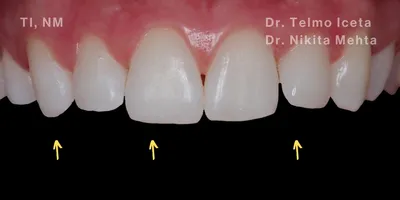 Close-up clinical view of the patient’s upper front teeth following teeth straightening and composite bonding treatment to restore the fractured edges and improve the shape of the teeth, performed by Dr Telmo Iceta and Dr Nikita Mehta.