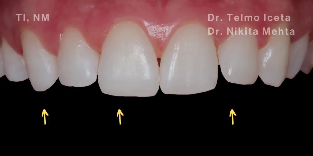 Close-up clinical view of the patient’s upper front teeth following teeth straightening and composite bonding treatment to restore the fractured edges and improve the shape of the teeth, performed by Dr Telmo Iceta and Dr Nikita Mehta.