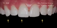 Close-up clinical view of the patient’s upper front teeth following teeth straightening and composite bonding treatment to restore the fractured edges and improve the shape of the teeth, performed by Dr Telmo Iceta and Dr Nikita Mehta.