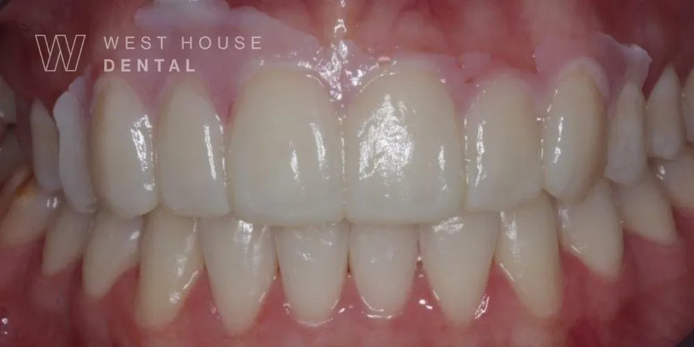 Close-up clinical photo of a patient with an in-mouth temporary composite bonding mock-up