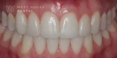 After teeth whitening and composite bonding by Dr Nikita Mehta