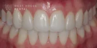 After teeth whitening and composite bonding by Dr Nikita Mehta