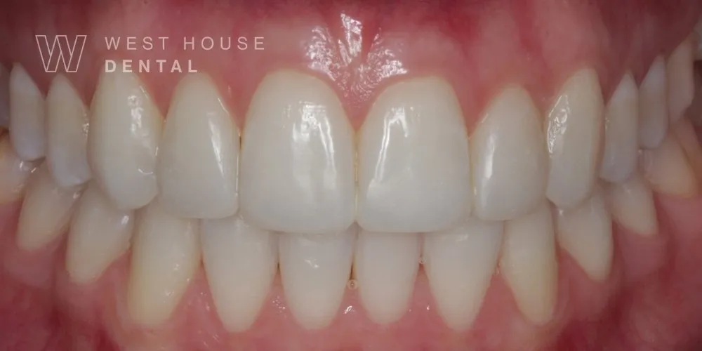 After teeth whitening and composite bonding by Dr Nikita Mehta
