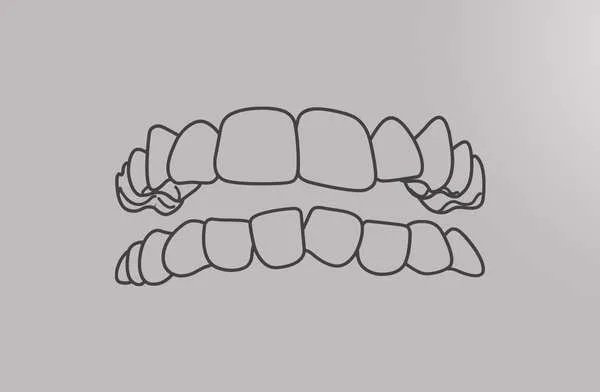 Close-up of a smile with crowded teeth