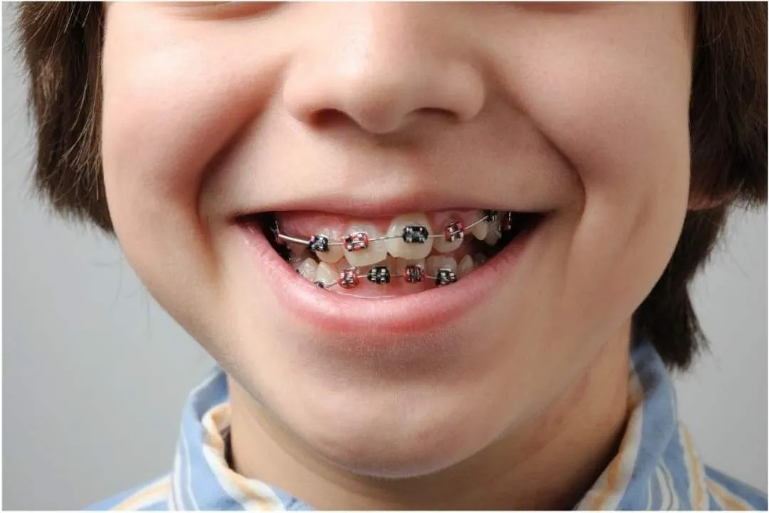 Smiling child with fixed braces