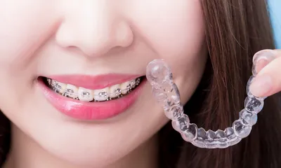 A close up of girl smiling with fixed braces and holding Invisalign in her hand