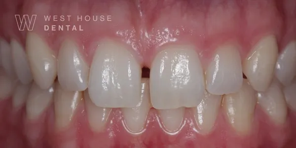 Close-up clinical view of a patient’s mouth showing a gap between the upper front teeth.