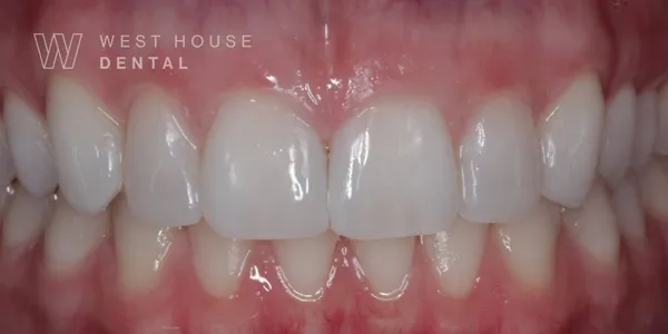 Close-up clinical view of the patient’s mouth following composite bonding treatment to close the gap between the upper front teeth.