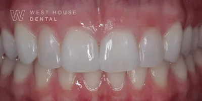 Close-up clinical view of the patient’s mouth following composite bonding treatment to close the gap between the upper front teeth.