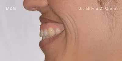 Close-up clinical view of a patient’s upper front teeth following orthodontic straightening and gum line correction. The teeth show minor unevenness and small chips at the biting edges, captured as a 'before' shot for dental edge bonding treatment.