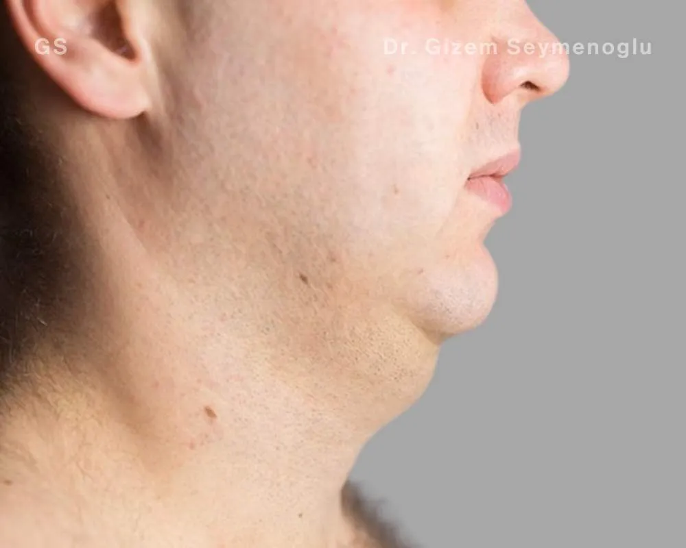 Close-up clinical view of patient before Aqualyx treatment showing a double chin and excess submental fat, captured as a 'before' shot for fat-dissolving injection treatment.