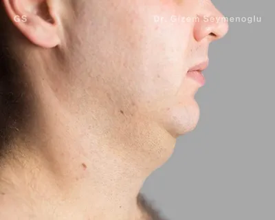 Close-up clinical view of patient before Aqualyx treatment showing a double chin and excess submental fat, captured as a 'before' shot for fat-dissolving injection treatment.