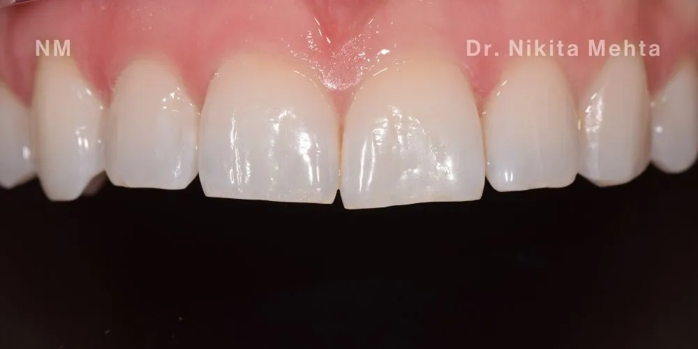 Close-up clinical view of a patient’s upper front teeth following orthodontic straightening and gum line correction. The teeth show minor unevenness and small chips at the biting edges, captured as a 'before' shot for dental edge bonding treatment.
