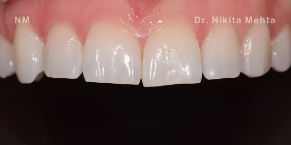 Close-up clinical view of a patient’s upper front teeth following orthodontic straightening and gum line correction. The teeth show minor unevenness and small chips at the biting edges, captured as a 'before' shot for dental edge bonding treatment.
