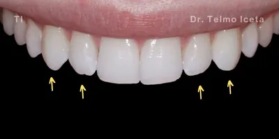 Close-up clinical view of the patient’s upper front teeth following teeth straightening and whitening treatment.
