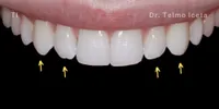 Close-up clinical view of the patient’s upper front teeth following teeth straightening and whitening treatment.