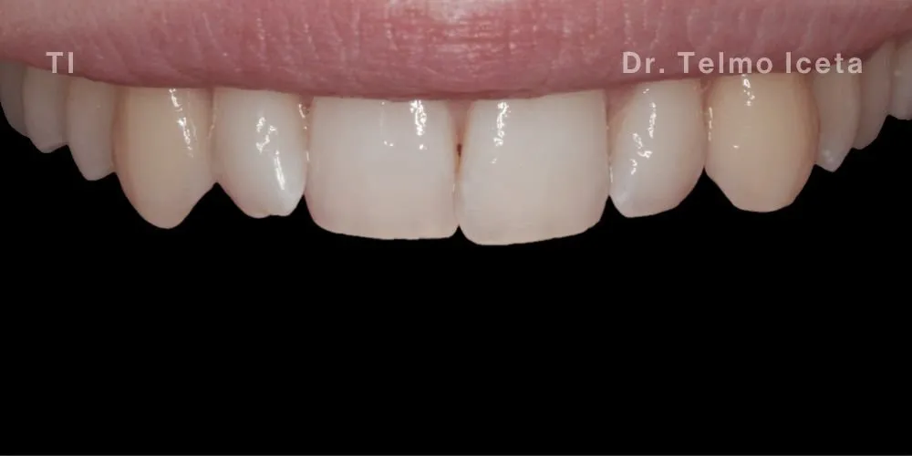 Close-up clinical view of a patient’s upper front teeth before orthodontic straightening and whitening.