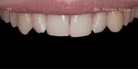 Close-up clinical view of a patient’s upper front teeth before orthodontic straightening and whitening.