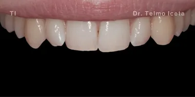 Close-up clinical view of a patient’s upper front teeth before orthodontic straightening and whitening.