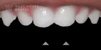 Post-treatment results of pediatric composite bonding on fractured upper front teeth. The arrows indicate the restored, smooth biting edges that have been rebuilt to aid speech and confidence in a toddler, performed by Dr Shabnam Zai