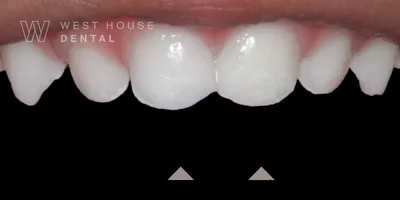 Post-treatment results of pediatric composite bonding on fractured upper front teeth. The arrows indicate the restored, smooth biting edges that have been rebuilt to aid speech and confidence in a toddler, performed by Dr Shabnam Zai