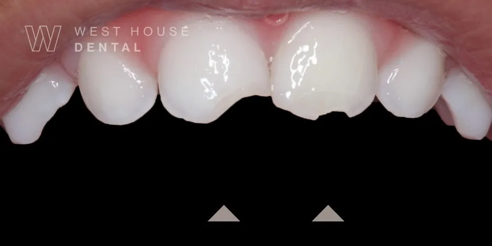 Close-up of a 36-month-old child’s upper front primary teeth showing fractures and jagged edges following a trauma incident.
