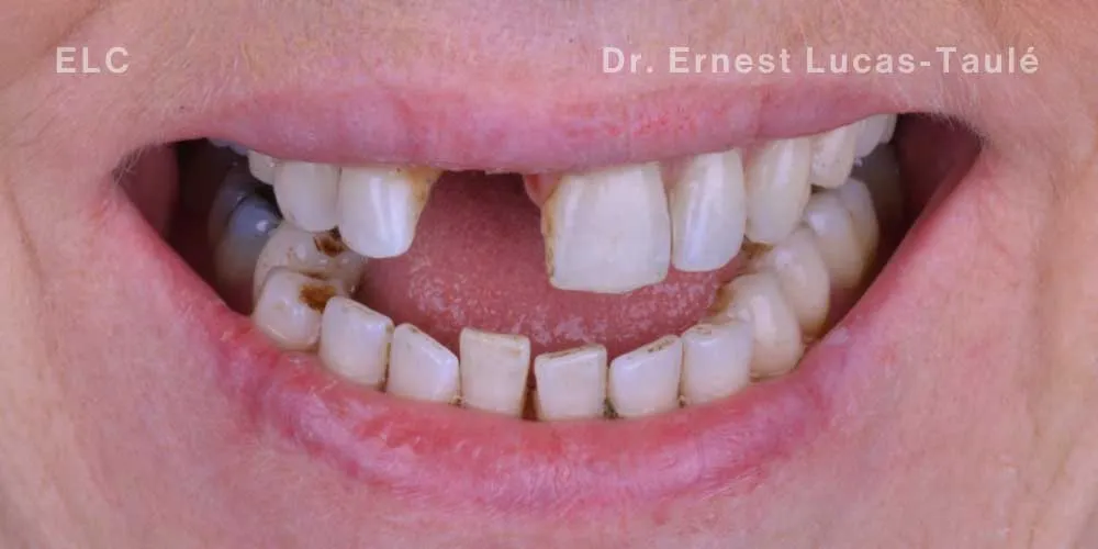 Close-up clinical view of a patient’s mouth with missing upper center tooth.