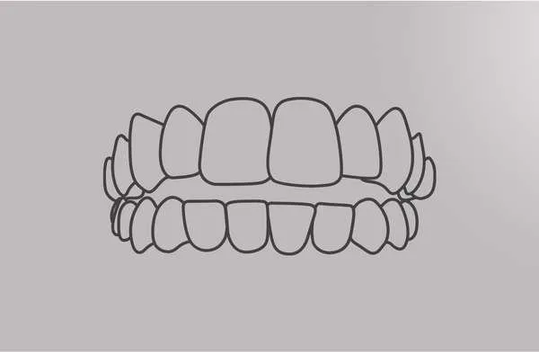Tooth diagram of a smile with open bite