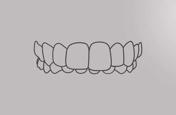 Tooth diagram of a smile with overbite
