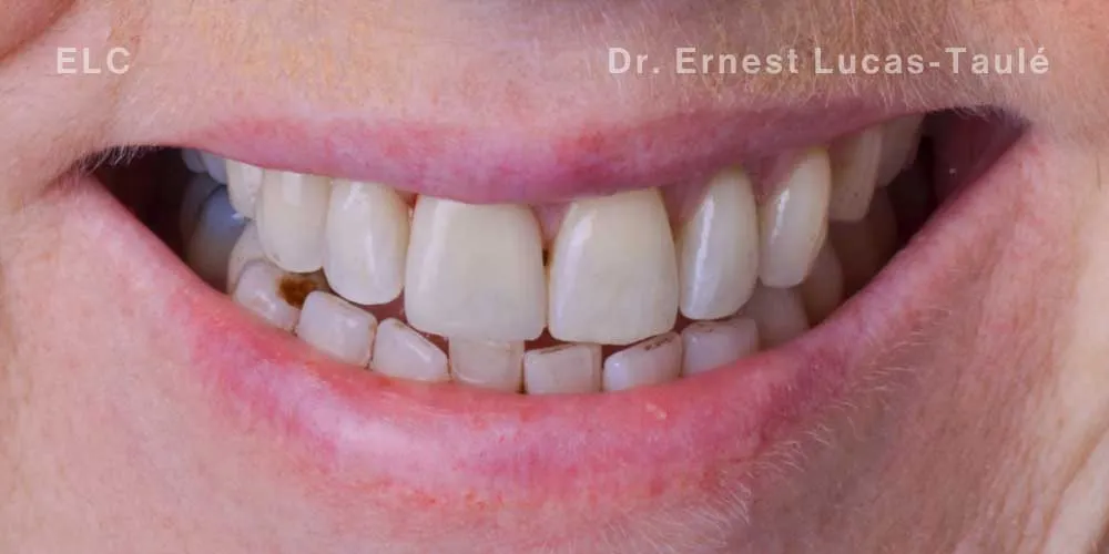 Close-up clinical view of the patient’s mouth with missing tooth replaced by a same-day implant.