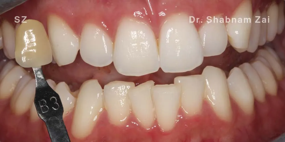 Close-up clinical view of the patient’s teeth following teeth whitening treatment. The teeth show a bright white hue (B1 shade), captured as an 'after' shot for dental whitening treatment.
