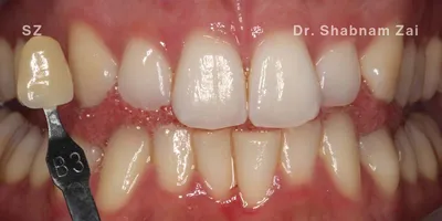 Close-up clinical view of a patient’s upper front teeth following orthodontic straightening and gum line correction. The teeth show minor unevenness and small chips at the biting edges, captured as a 'before' shot for dental edge bonding treatment.