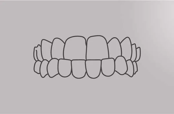 Tooth diagram of a smile with overbite
