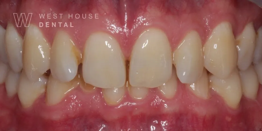 Close-up clinical view of a patient’s upper front teeth following orthodontic straightening and gum line correction. The teeth show minor unevenness and small chips at the biting edges, captured as a 'before' shot for dental edge bonding treatment.